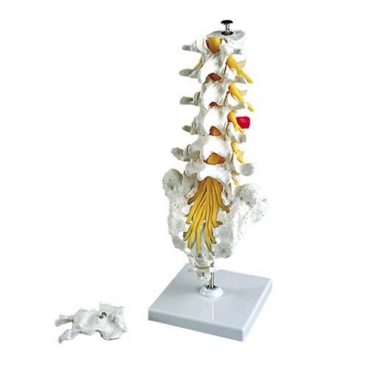 modelo-columna-vertebral-lumbar-con-hernia-discal-dorsolateral