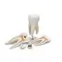 Modelo de molar superior con caries D15 3B Scientific