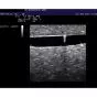 Simulador para la escleroterapia dirigida por ultrasonido en caso de varices P60