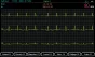 Pack promocional ECG Spengler Cardiomate 3 (3 pistas) con interpretación