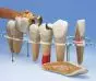 Modelo de prótesis dental, 7 piezas, 10 veces su tamaño natural - Alemán W42528