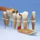 Modelo de prótesis dental, 7 piezas, 10 veces su tamaño natural - francés 3B - W42529