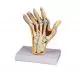 Modelo de mano con artritis reumatoide M26 Erler Zimmer