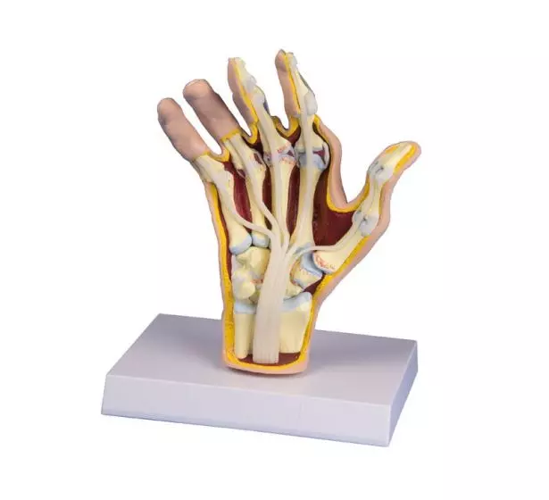 Modelo de mano con artritis reumatoide M26 Erler Zimmer