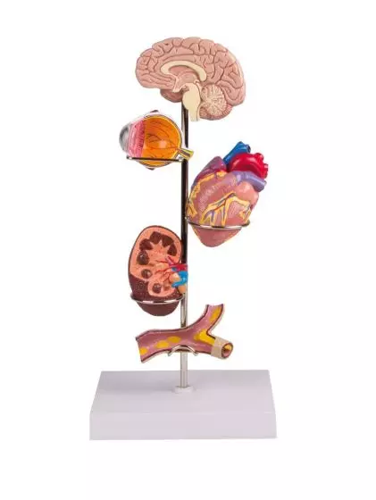 Modelo anatómico de órganos con hipertensión G37 Erler Zimmer