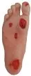 Modelo de pie diabético con úlceras R50067 Erler Zimmer