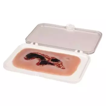 Modelo de una úlcera arterial en la pierna en fase de exudación