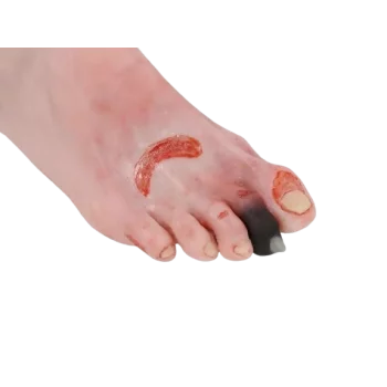 Modelo de pie lesionado con síndrome del pie diabético Erler Zimmer