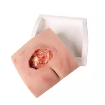 Modelo de úlcera por presión sacra desinfectada Erler Zimmer - Con soporte