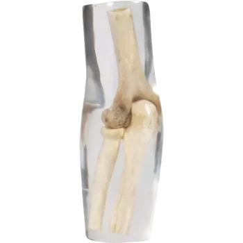 Erler Zimmer Radiografía de codo fantasma