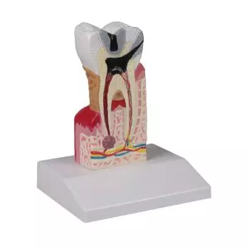 Modelo de molar con caries aumentado 10 veces - D214 Erler Zimmer