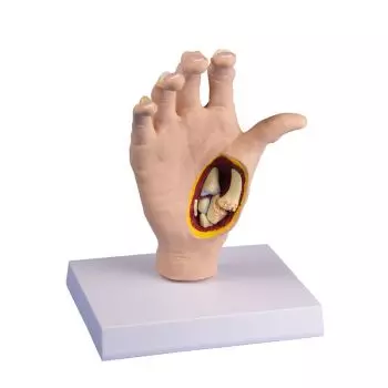 Modelo de mano con artrosis M25 Erler Zimmer