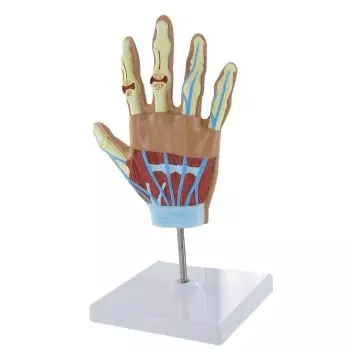Modelo de mano con artritis