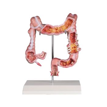 Modelo de intestino con enfermedades Erler Zimmer