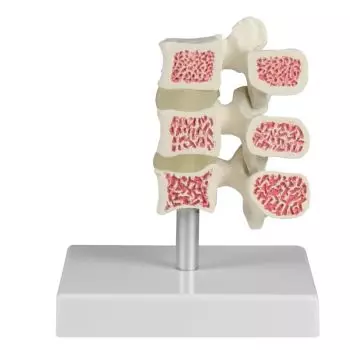 Modelo de 3 vértebras con osteoporosis 4078 Erler Zimmer