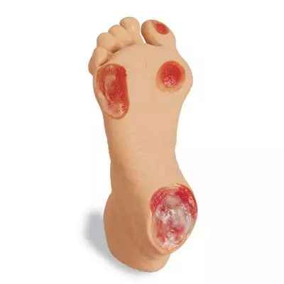 Pie de persona mayor con úlcera por presión W44757