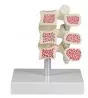 Modelo de 3 vértebras con osteoporosis 4078 Erler Zimmer