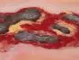 Modelo de una úlcera arterial en la pierna en fase de exudación