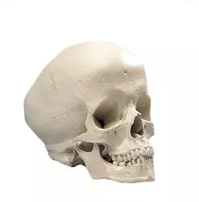 Cráneo Hidrocefálico 3B scientific - A29/2