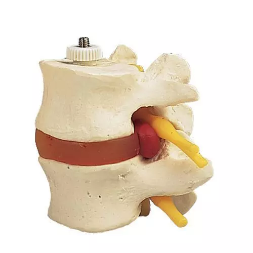 Discos lumbares con hernia discal. Montados flexibles sobre soporte 3B scientific A76/9
