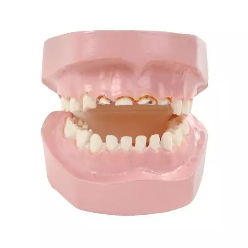 Modelo de deterioro dental por caries del biberón 3B Scientific W43157 