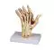 Modelo de mano con artritis reumatoide M26 Erler Zimmer