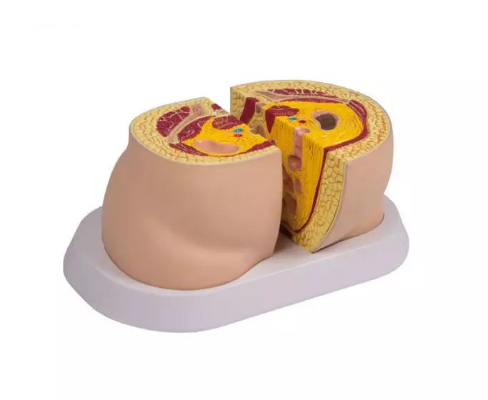 Modelo de tipos de obesidad M50 Erler Zimmer