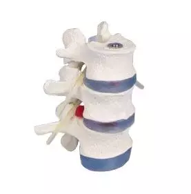 Modelo de vértebras lumbares con hernia discal 4048 Erler Zimmer