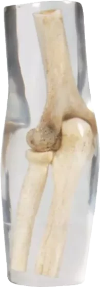 Erler Zimmer Radiografía de codo fantasma