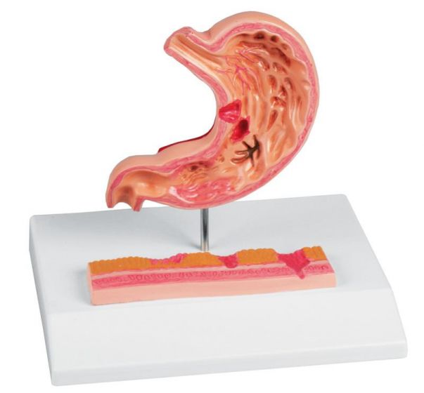 Modelo de estómago con úlcera péptica Erler Zimmer 