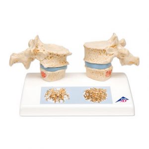 Modelo de osteoporosis A95
