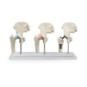 Modelo de prótesis de cadera 1115 Erler Zimmer