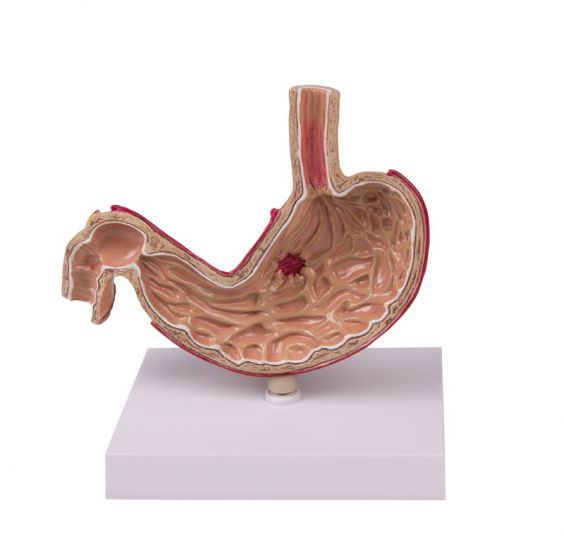 Modelo de estómago con úlceras K80 Erler Zimmer
