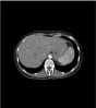 Fantasma abdominal para tomografía computarizada, radiografía y radioterapia de Erler Zimmer
